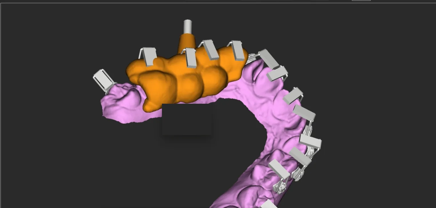Eine Verankerungsimplantat-Schablone mit Hülse auf einem Zahnbogen mit Brackets