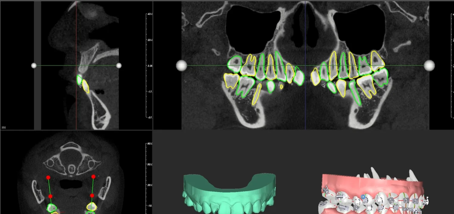 Verankerungsimplantate auf CBCT-Schichten mit segmentierten Zähnen in GuideMia OrthoPlus geplant