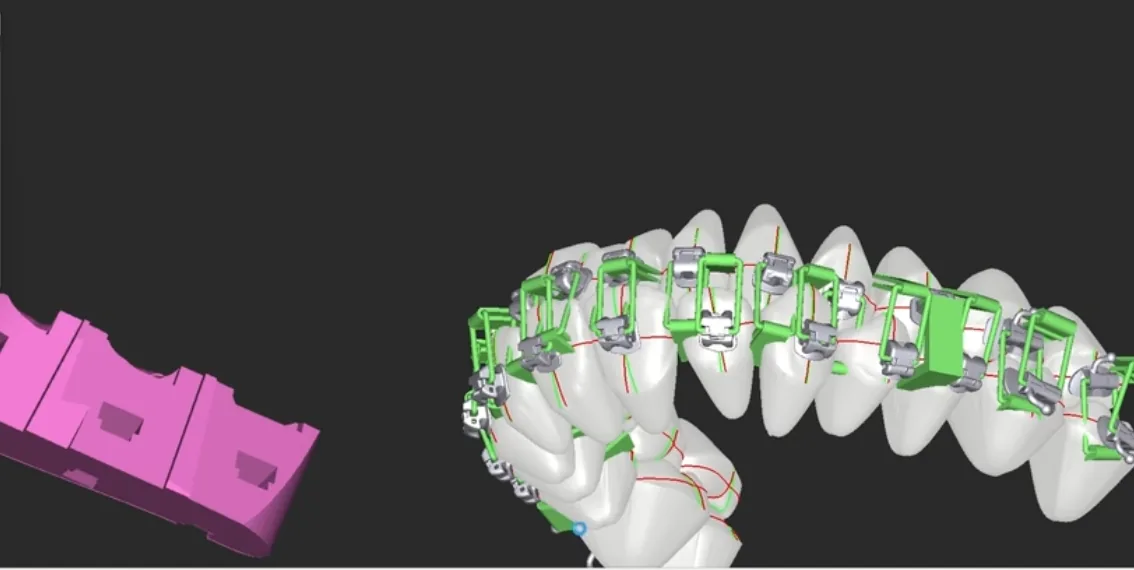 Jig-Rahmen im Gauge-Stil über Brackets mit der segmentierten Bonding-Schablone