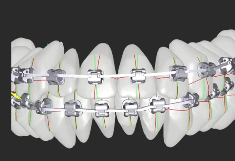 Brackets mit ADB-Jigs auf einem digitalen Bogen-Setup in GuideMia OrthoPlus