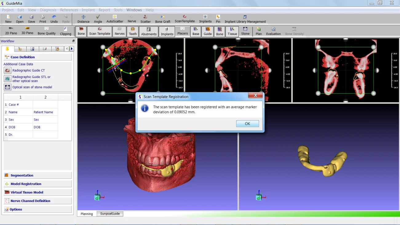 Radiographic guide registered with the patient scan