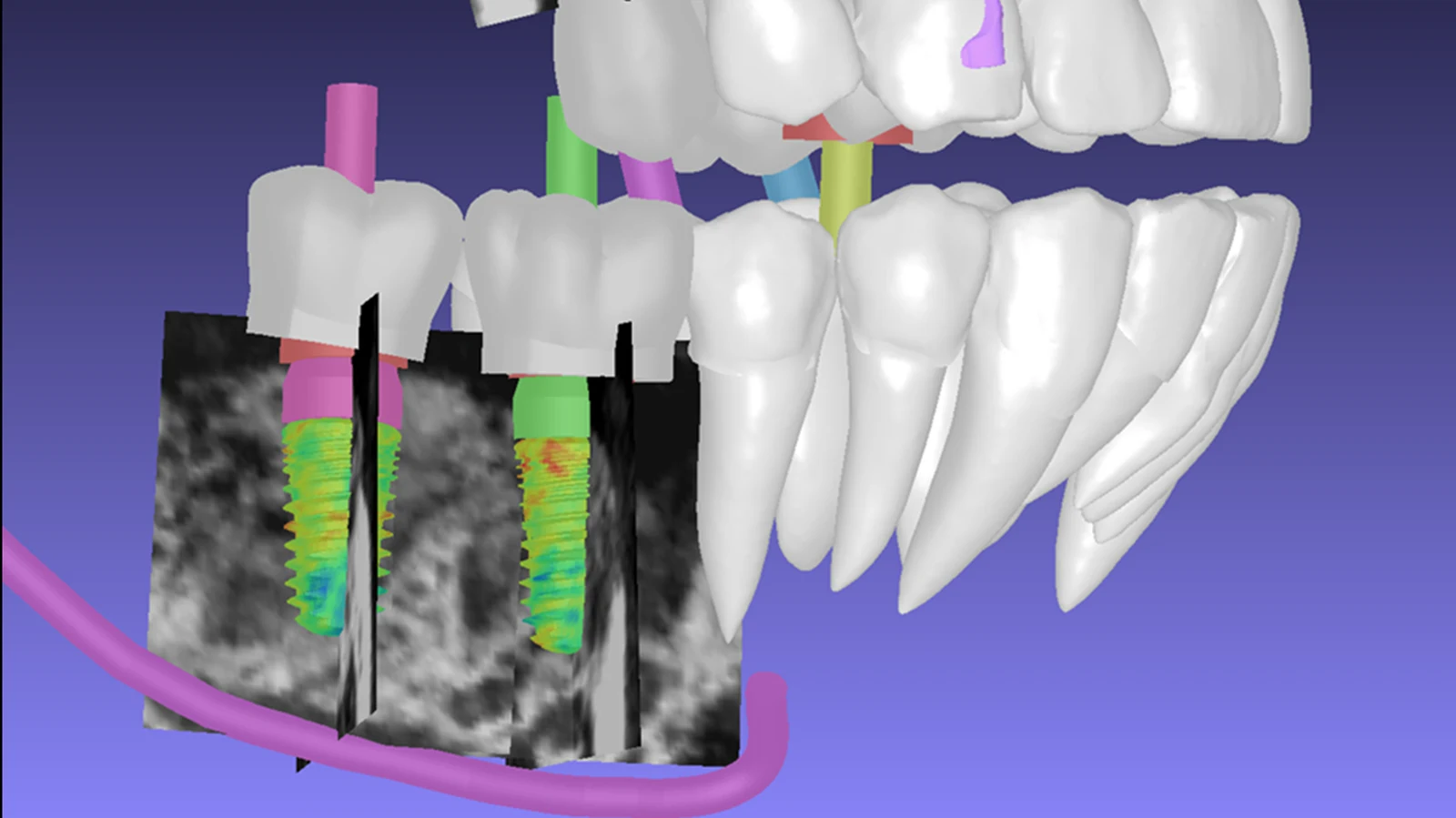Impianti con mappa di colore sulla densità ossea all'interno delle sezioni CBCT, con le radici dentali e il canale mandibolare