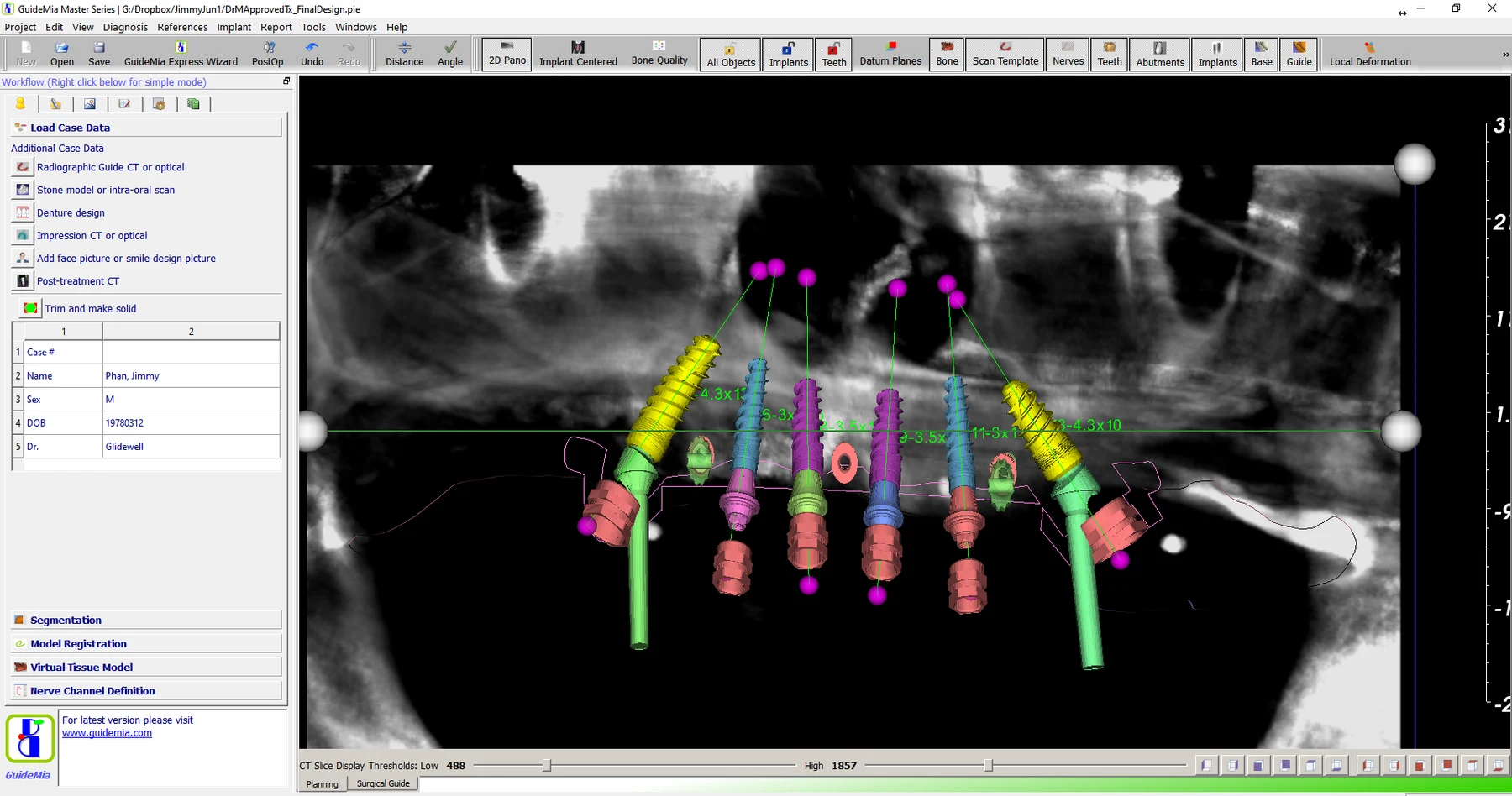 GuideMia Implant Master mostra impianti e monconi pianificati su una ricostruzione panoramica CBCT con il canale mandibolare tracciato