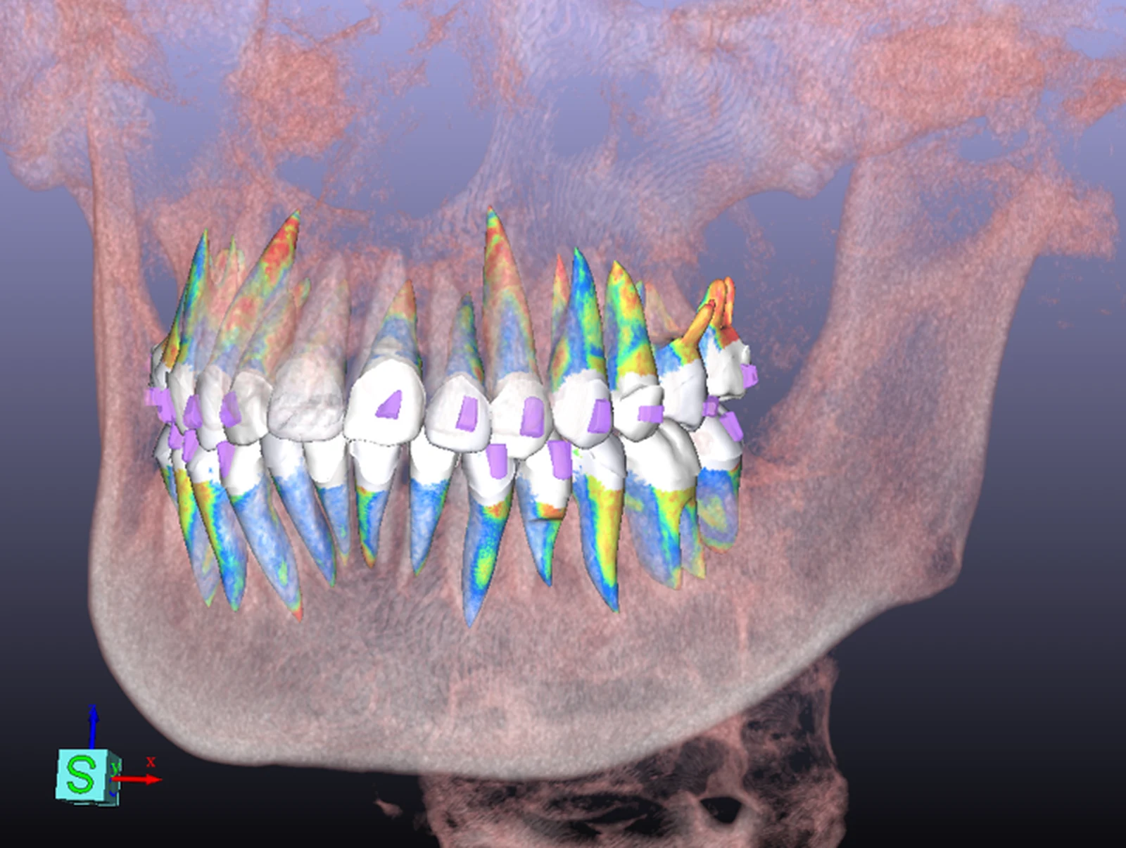 Rendering volumetrico CBCT con le radici dentali colorate singolarmente all'interno del mascellare traslucido