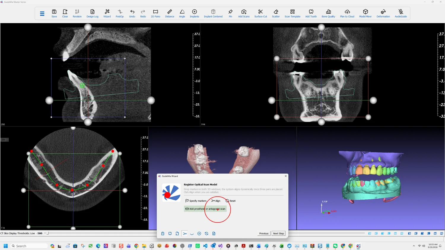 Add prosthesis or antagonist scan