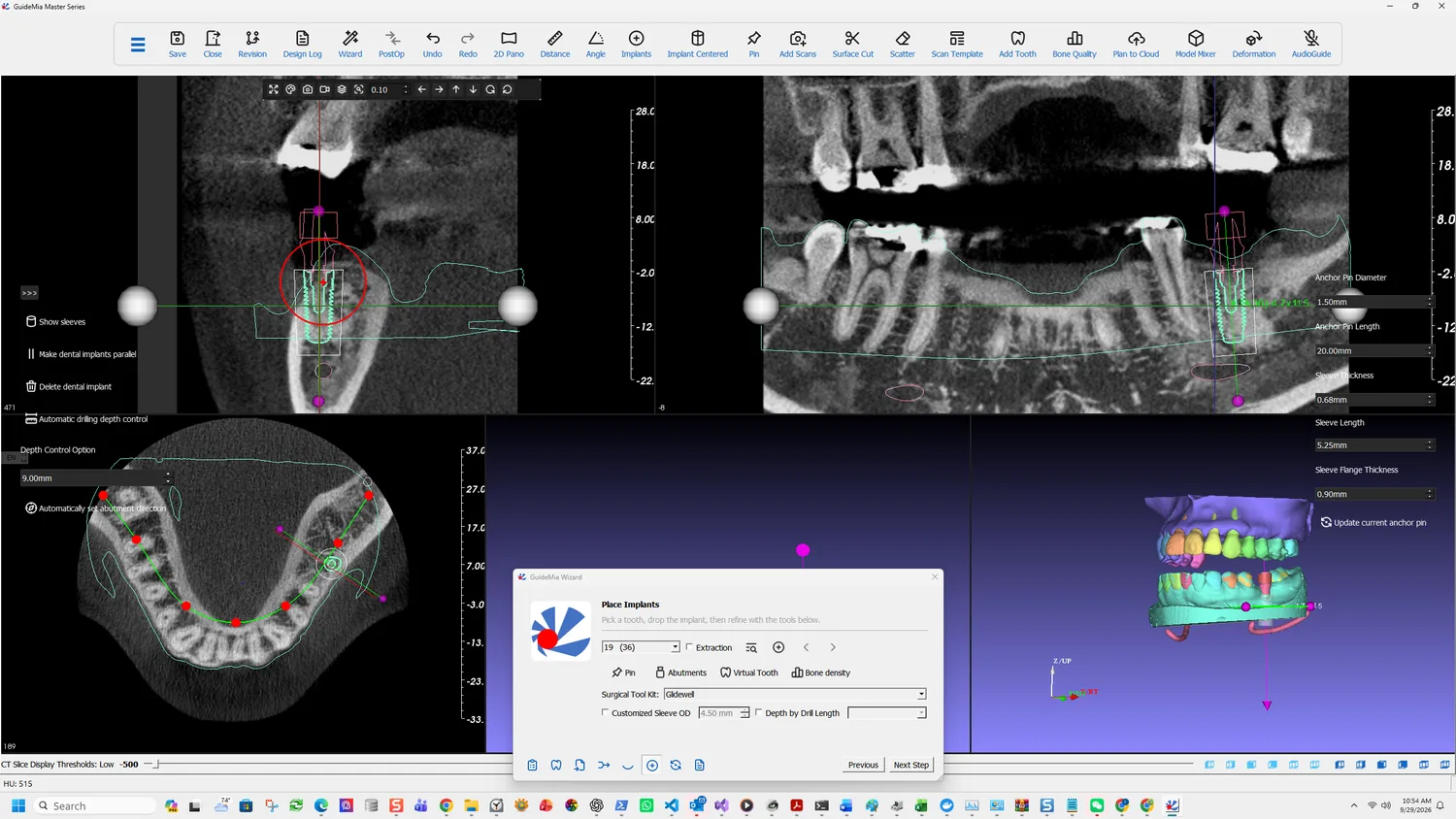 Checking the fixture on the coronal view
