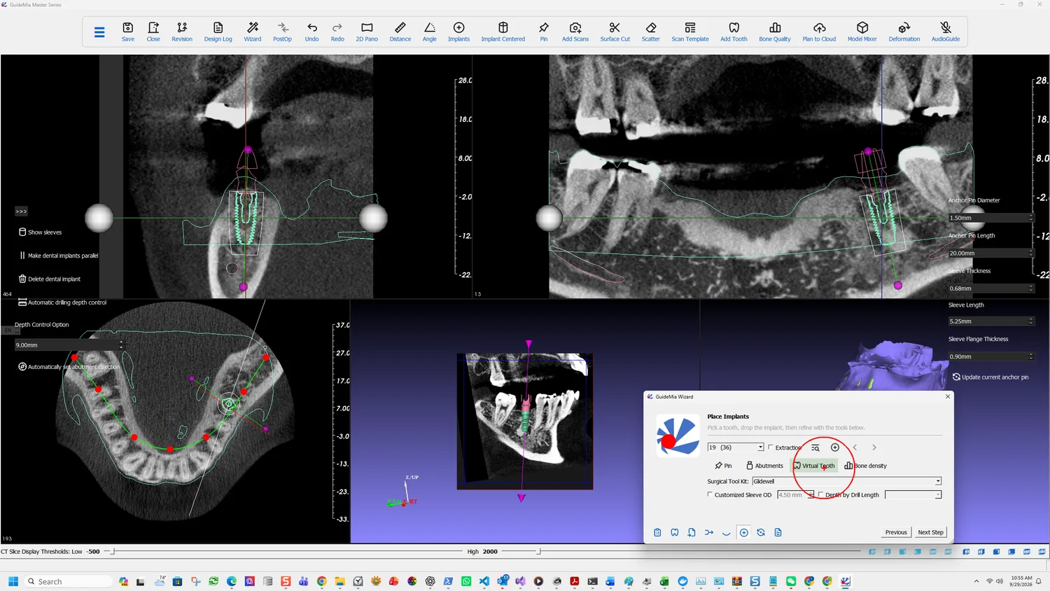 Add Virtual Tooth
