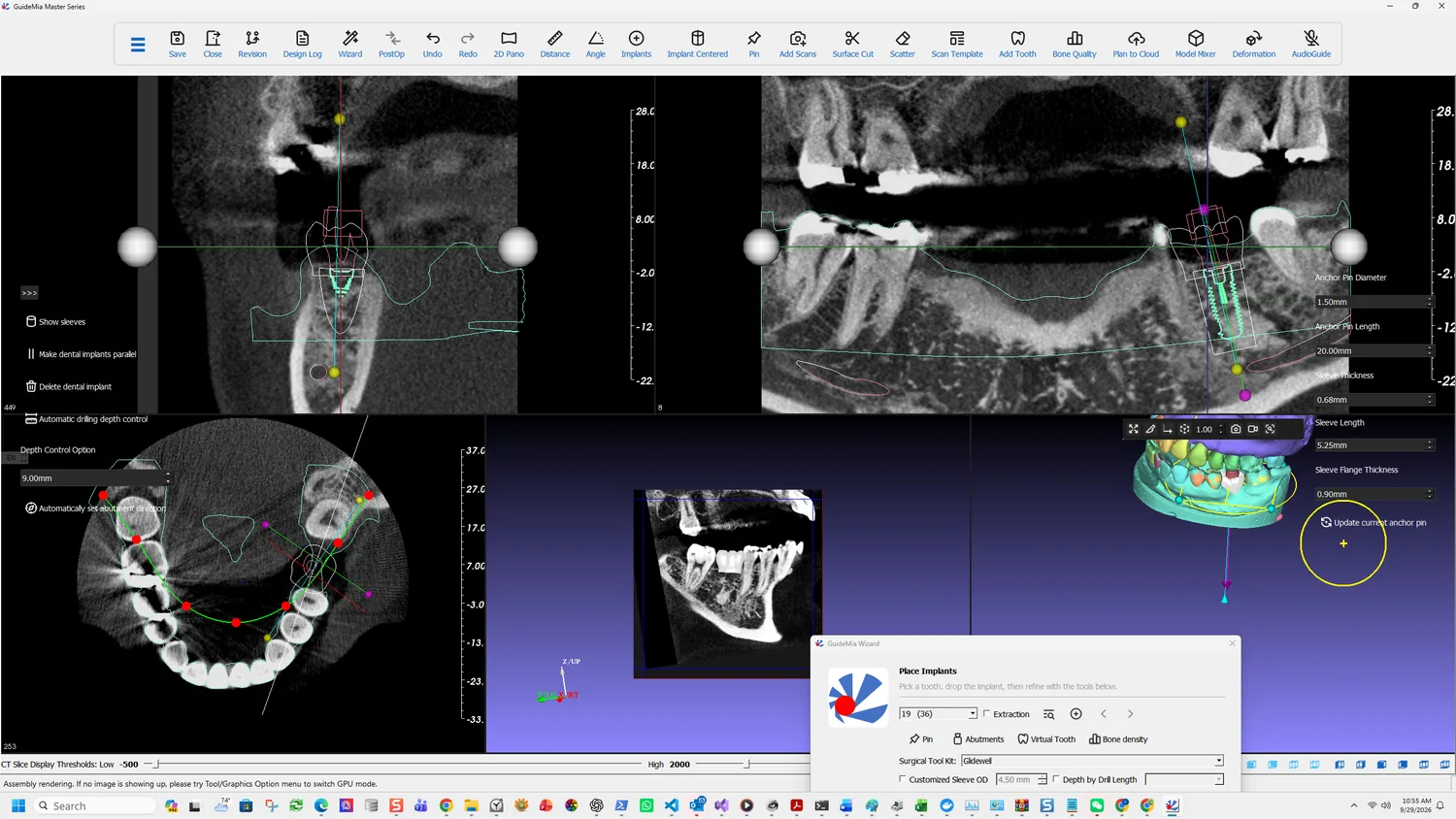 The virtual tooth in place