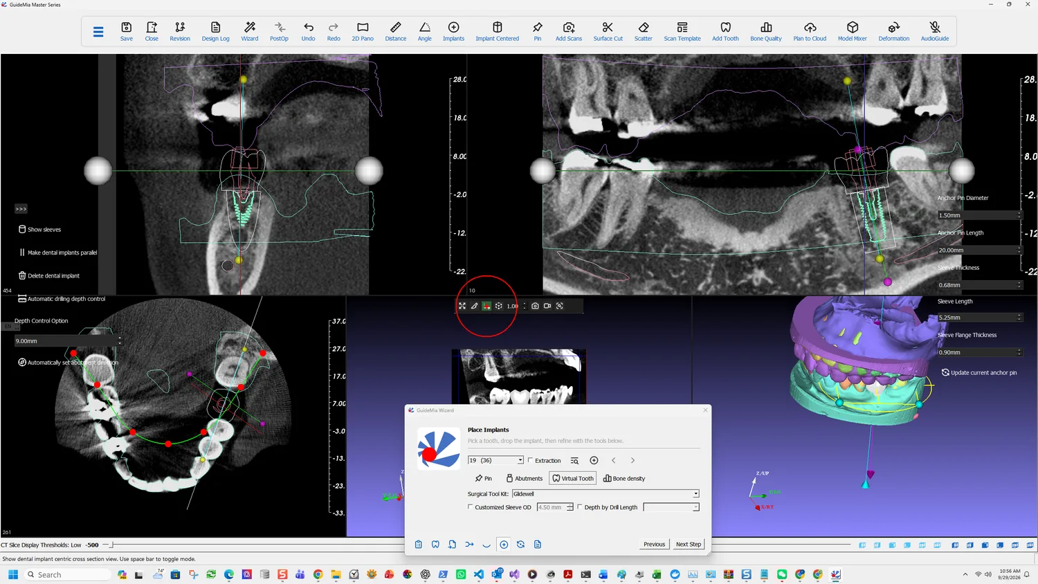The implant-centric cross section, used for the final check