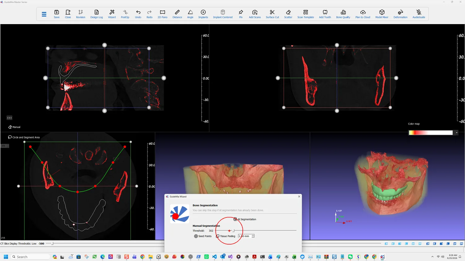 Setting the bone threshold
