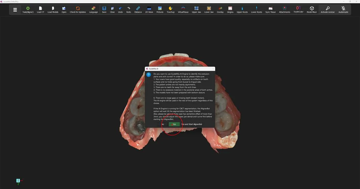 Both arches loaded and in occlusion, ready for the workflow to begin.