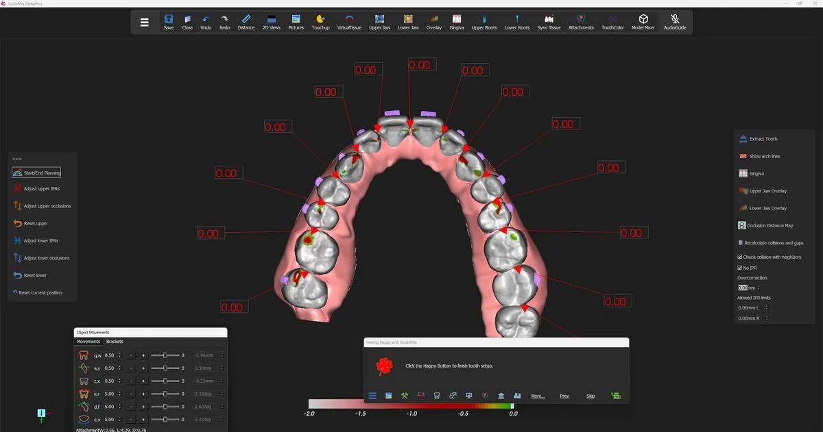 The occlusal distance map on the upper arch, with its −2.0 to 0.0 mm scale.