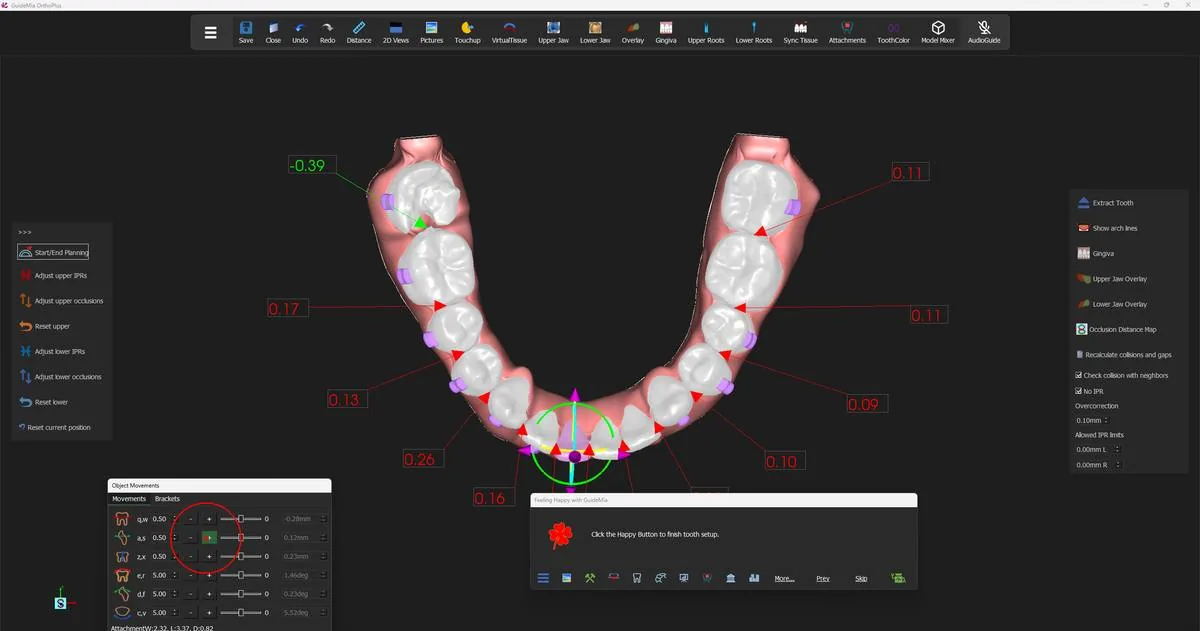 Moving a lower incisor by hand, with the interproximal collision and gap values live along the arch.