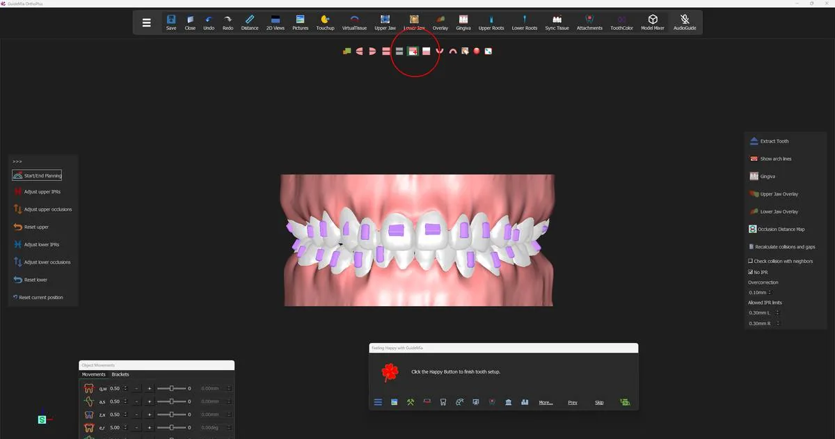 The upper and lower anteriors from the front, mid-setup.