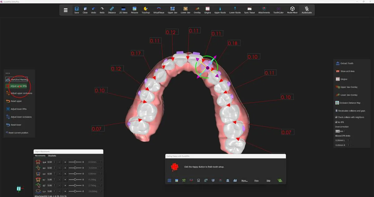 The upper arch after its own IPR pass.