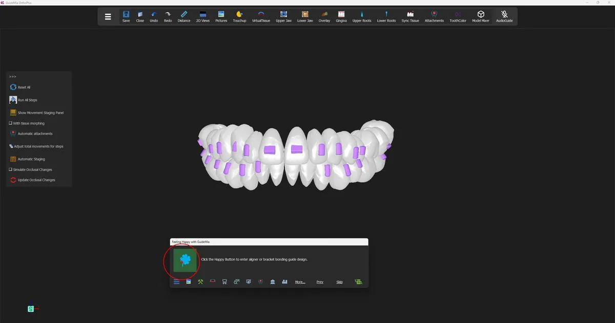 The teeth carrying their first set of attachments, with the Happy Button about to open aligner design.