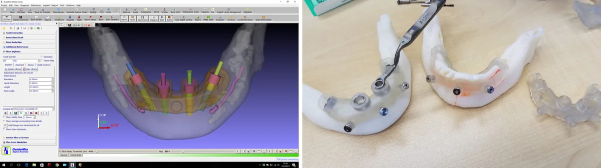 用 GuideMia Implant Master 设计的切骨导板