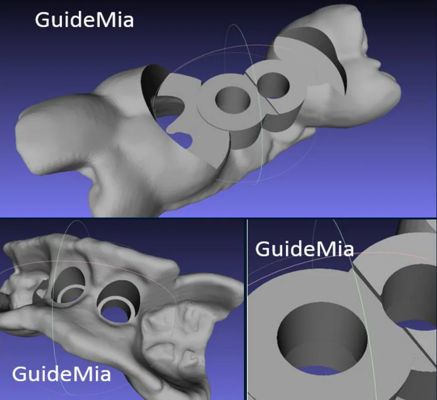 GuideMia Implant Master 的倒凹处理结果