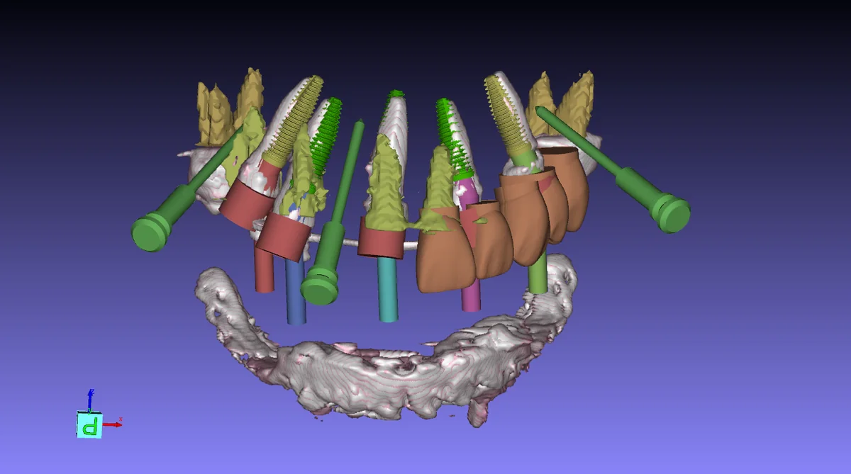 GuideMia Implant Master 中的术前术后对比