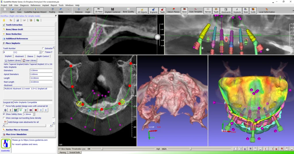 Captura de pantalla de GuideMia Implant Master