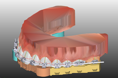Diseño de guía de cementado de brackets